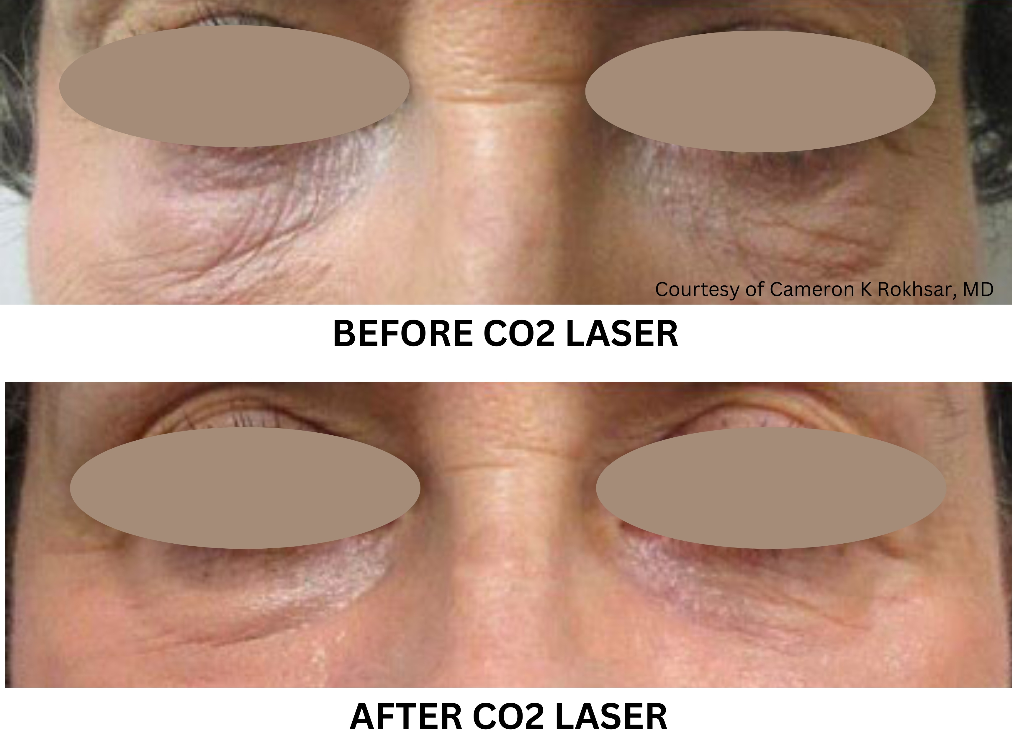 Before-and-after photos of the under-eye area showing improvement in skin texture and fine lines following CO₂ laser treatment.