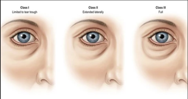 Illustration showing three classifications of under-eye bags. Class I is mild and limited to the tear trough area. Class II is moderate and extends laterally. Class III is severe with full bulging under the eye.