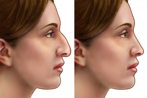 Hirmand_Rhinoplasty_0.jpg