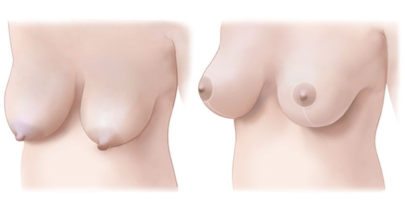 BreastMastopexy.png