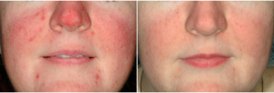 ipl intense pulsed light cynosure courtesy rosacea